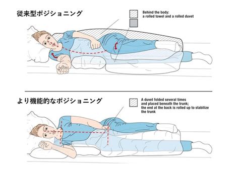 背位|背臥位のポジショニング、メリット、姿勢修正を解。